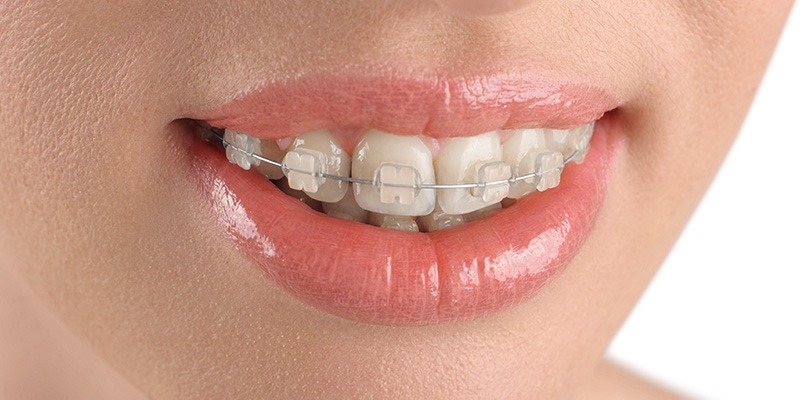 Orthodontic Treatment Age