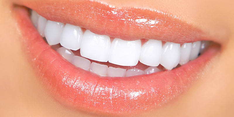 Teeth Whitening