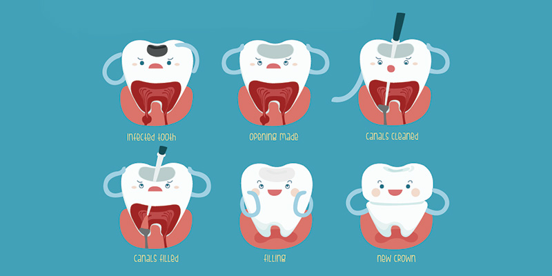 Endodontics (Root Canal Treatment)