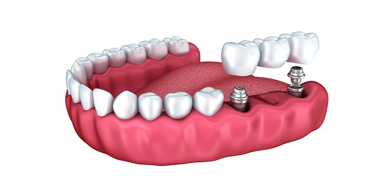 implant-dis-tedavisi-2