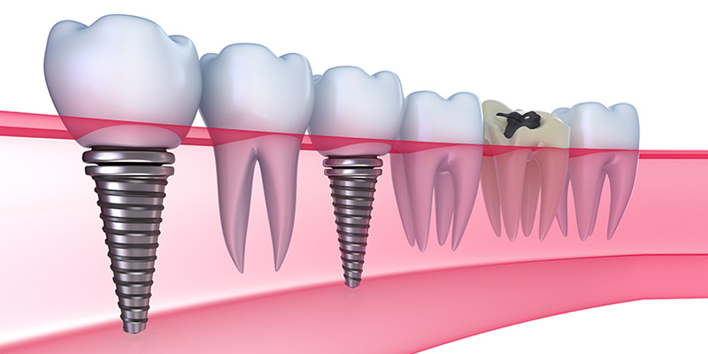 Implant Treatments